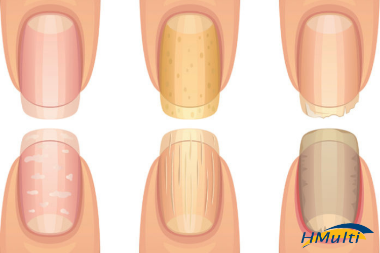Tipos mais comuns de doenças nas unhas Tipos mais comuns de doenças nas unhas