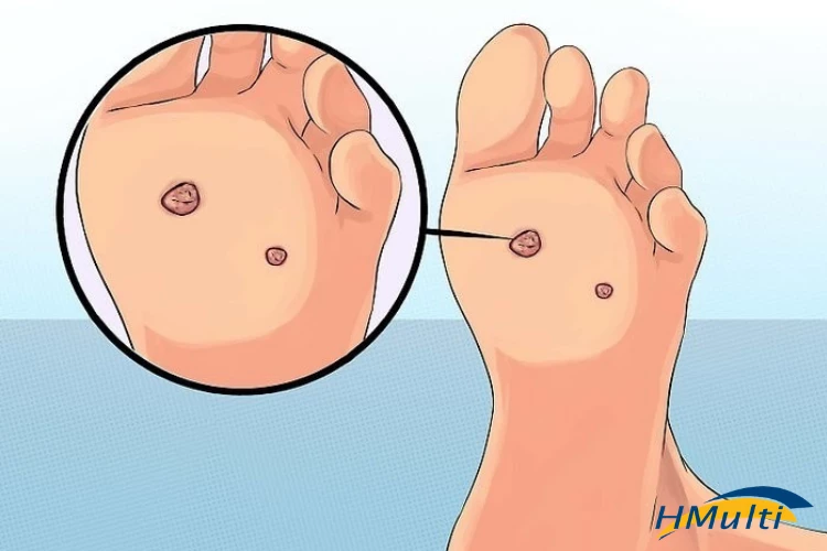 Verruga plantar: causas, sintomas e tratamento